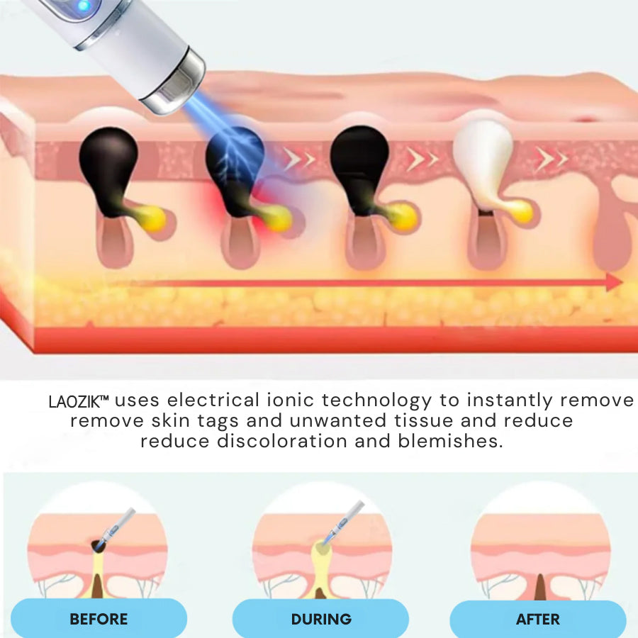 LAOZIK® Non-Invasive Mole and Wart Removal Laser Pen