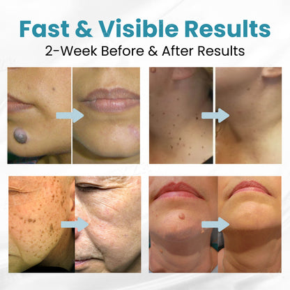 LAOZIK® Non-Invasive Mole and Wart Removal Laser Pen